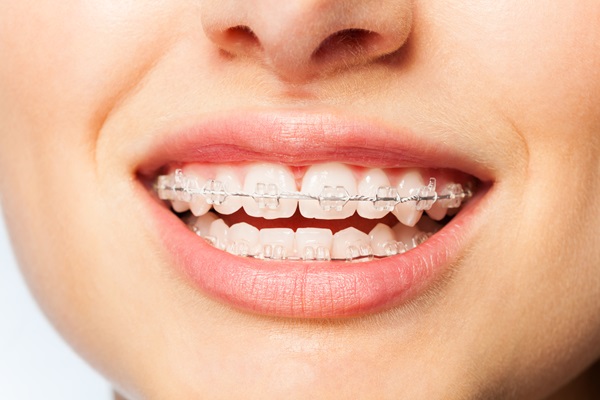 How Clear Braces Can Give You Straighter Teeth