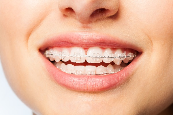 Get a Straighter Smile with Clear Braces  Uplands Dental in Thornhill,  Ontario — Uplands Dental