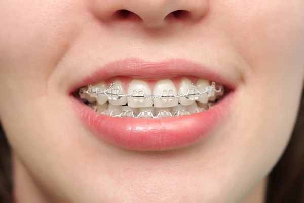 Clear Braces: What Foods Should You Avoid?