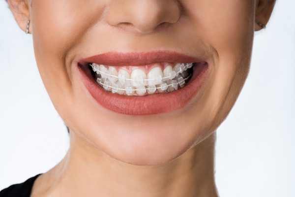 Clear Braces Vs  Invisalign: Which Smile Straightening Option Is Better?
