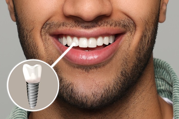 Eating And Speaking With Dental Implants