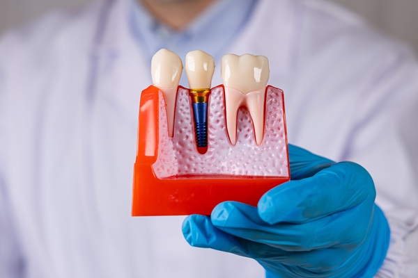 Who Needs A Dental Implant Restoration?