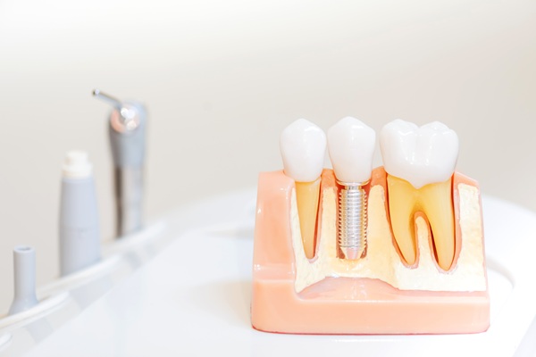 Am I A Candidate For Implant Restoration?